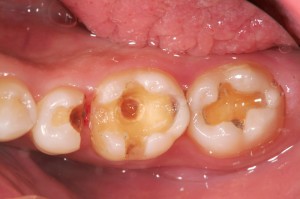 歯と歯の間の虫歯を治したはずなのに内部にはまた虫歯が…