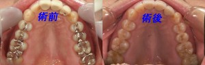 部分的な銀歯はダイレクトボンディング、被せ物はE-maxで修復