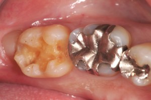 銀歯がとれて来院。虫歯の部分は丁寧に除去した後です。