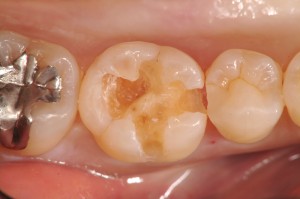 う蝕検知液で染まらなくなるまで丁寧に虫歯部分だけを除去します