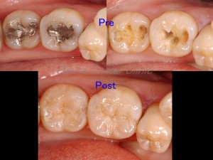銀の詰め物を除去し、虫歯をきれいにとってダイレクトボンディングで自然な歯に仕上げました。