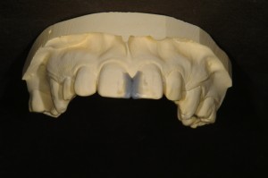 左右の歯の幅が等しくなるように模型上にワックスアップします。