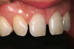 側切歯先天性割損の為2番目にあるのは犬歯。