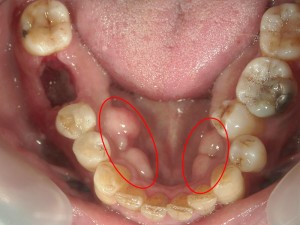 ここ（赤丸部分）に球状の骨のでっぱりがあったら歯ぎしりの証拠。